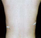 After Hair Removal patient