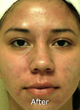 Patient 8 after photo of Acne & Acne Scar Laser Treatment patient at Sensational Skin Scottsdale