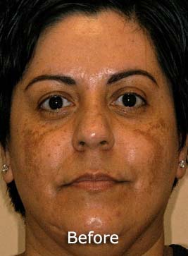 Patient 6 before photo of Obagi™ Systems patient at Sensational Skin Scottsdale