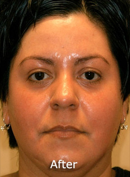 Patient 6 after photo of Obagi™ Systems patient at Sensational Skin Scottsdale