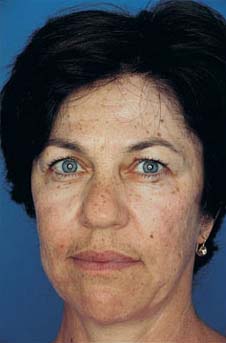 Patient 7 before photo of Obagi™ Systems patient at Sensational Skin Scottsdale