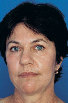 Patient 7 after photo of Obagi™ Systems patient at Sensational Skin Scottsdale
