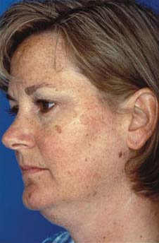 Patient 8 before photo of Obagi™ Systems patient at Sensational Skin Scottsdale
