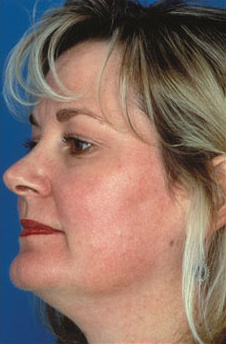 Patient 8 after photo of Obagi™ Systems patient at Sensational Skin Scottsdale