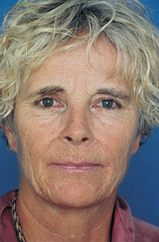 Patient 9 before photo of Obagi™ Systems patient at Sensational Skin Scottsdale