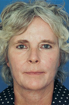 Patient 9 after photo of Obagi™ Systems patient at Sensational Skin Scottsdale