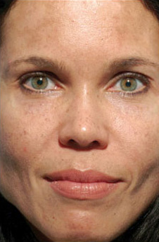 Patient 11 before photo of Obagi™ Systems patient at Sensational Skin Scottsdale
