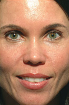 Patient 11 after photo of Obagi™ Systems patient at Sensational Skin Scottsdale