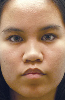 Patient 12 before photo of Obagi™ Systems patient at Sensational Skin Scottsdale