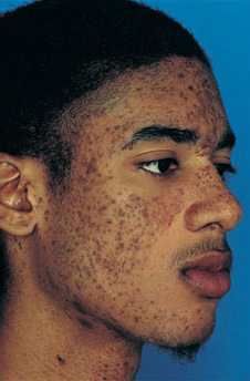 Patient 13 before photo of Obagi™ Systems patient at Sensational Skin Scottsdale