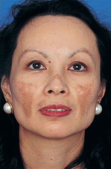 Patient 14 before photo of Obagi™ Systems patient at Sensational Skin Scottsdale
