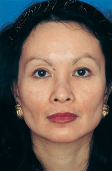 Patient 14 after photo of Obagi™ Systems patient at Sensational Skin Scottsdale