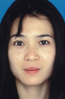 Patient 15 before photo of Obagi™ Systems patient at Sensational Skin Scottsdale