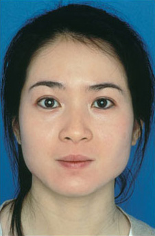 Patient 15 after photo of Obagi™ Systems patient at Sensational Skin Scottsdale