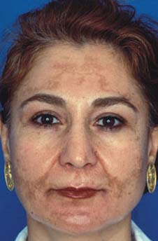 Patient 16 before photo of Obagi™ Systems patient at Sensational Skin Scottsdale