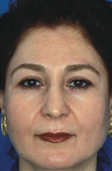 Patient 16 after photo of Obagi™ Systems patient at Sensational Skin Scottsdale