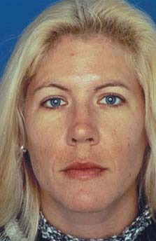 Patient 17 before photo of Obagi™ Systems patient at Sensational Skin Scottsdale