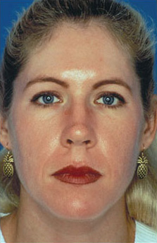 Patient 17 after photo of Obagi™ Systems patient at Sensational Skin Scottsdale