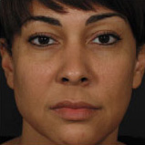 Patient 18 before photo of Obagi™ Systems patient at Sensational Skin Scottsdale