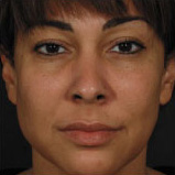 Patient 18 after photo of Obagi™ Systems patient at Sensational Skin Scottsdale