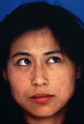 Patient 19 before photo of Obagi™ Systems patient at Sensational Skin Scottsdale