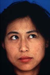 Patient 19 before photo of Obagi™ Systems patient at Sensational Skin Scottsdale