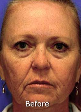 Patient 7 before photo of Active FX™ Laser Skin Tightening patient at Sensational Skin Scottsdale