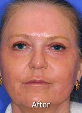 Patient 7 after photo of Active FX™ Laser Skin Tightening patient at Sensational Skin Scottsdale
