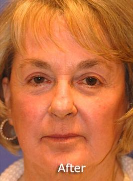 Patient 8 after photo of Active FX™ Laser Skin Tightening patient at Sensational Skin Scottsdale