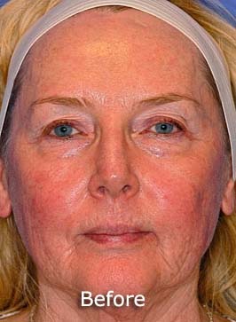 Patient 9 before photo of Active FX™ Laser Skin Tightening patient at Sensational Skin Scottsdale
