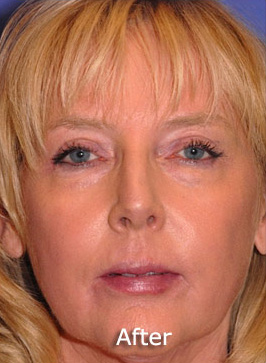Patient 9 after photo of Active FX™ Laser Skin Tightening patient at Sensational Skin Scottsdale