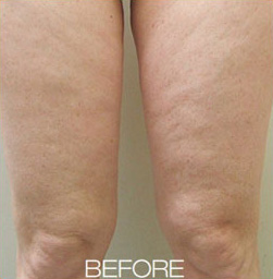 Before VelaShape patient