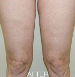 After VelaShape patient