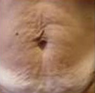 Before VelaShape patient