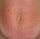 After VelaShape patient