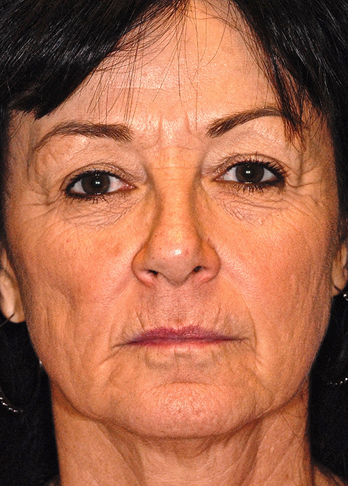 Patient 2 before photo of Active FX™ Laser Skin Tightening patient at Sensational Skin Scottsdale