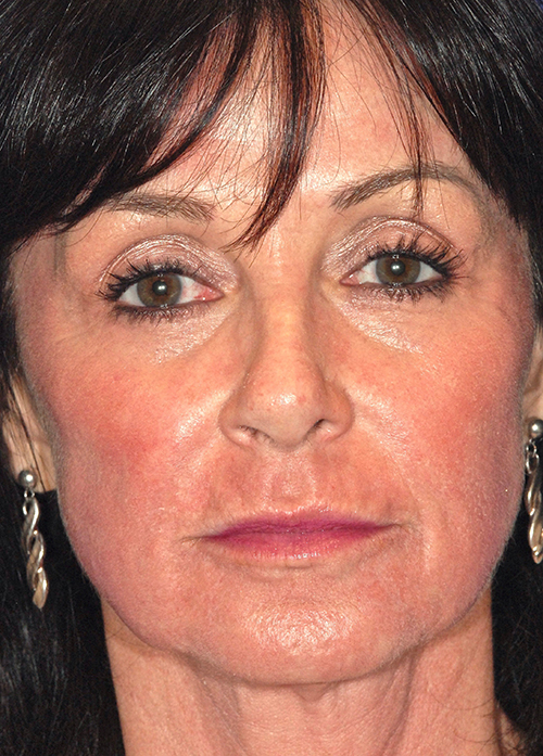 Patient 2 after photo of Active FX™ Laser Skin Tightening patient at Sensational Skin Scottsdale