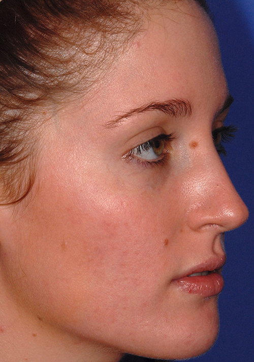 Patient 4 after photo of Acne & Acne Scar Laser Treatment patient at Sensational Skin Scottsdale