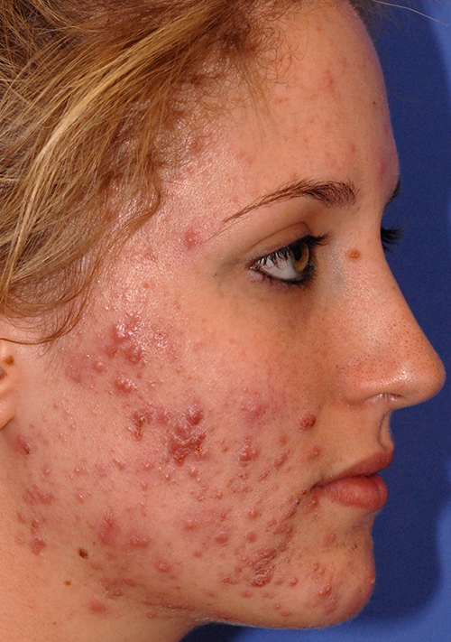 Patient 4 before photo of Acne & Acne Scar Laser Treatment patient at Sensational Skin Scottsdale