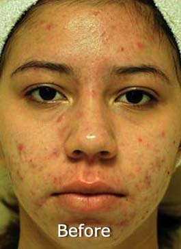 Patient 8 before photo of Acne & Acne Scar Laser Treatment patient at Sensational Skin Scottsdale