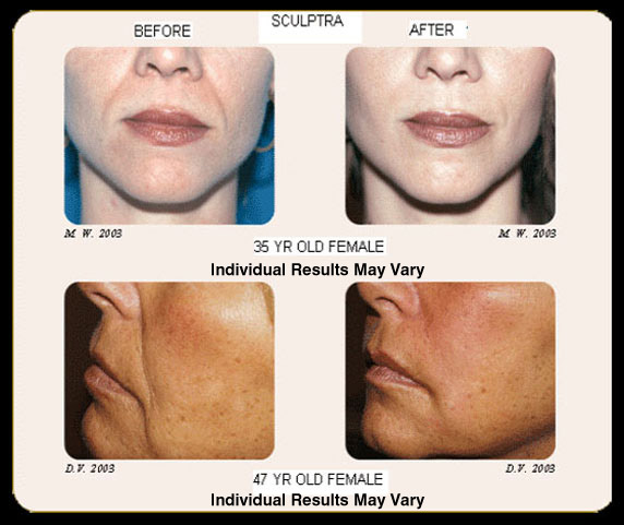 Facial Fillers & Injectables Scottsdale