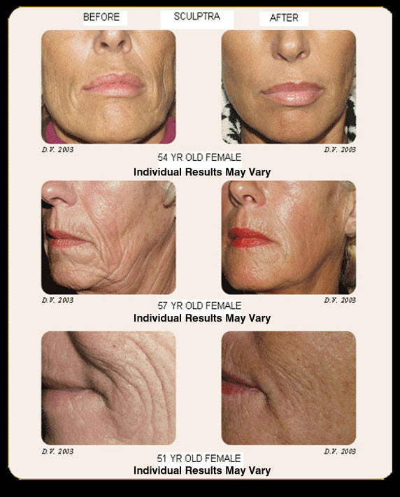 Facial Fillers & Injectables Scottsdale