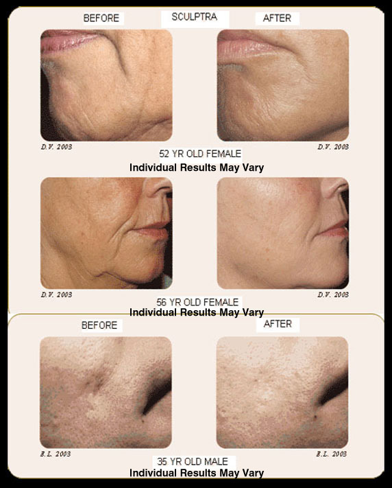 Facial Fillers & Injectables Scottsdale
