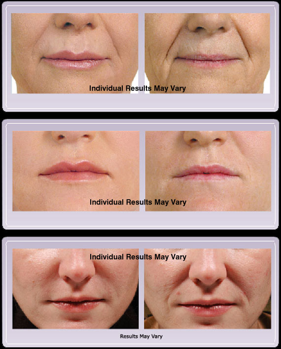 Facial Fillers & Injectables Scottsdale