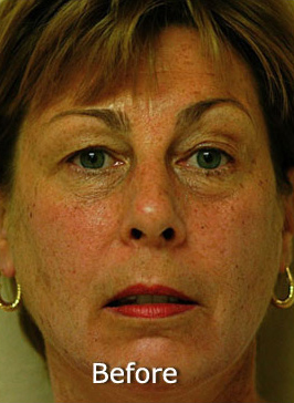 Patient 6 before photo of Photo Facial™ patient at Sensational Skin Scottsdale