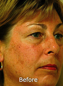 Patient 6 before photo of Photo Facial™ patient at Sensational Skin Scottsdale