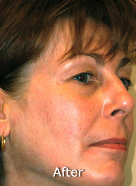 Patient 6 after photo of Photo Facial™ patient at Sensational Skin Scottsdale