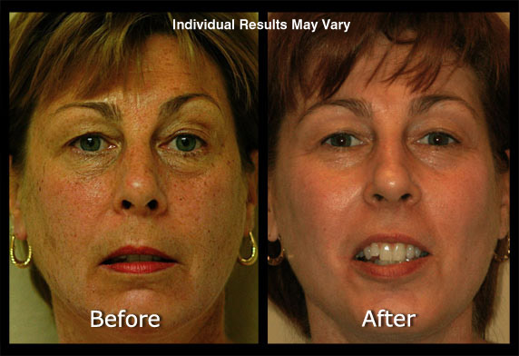 Photofacial Before and After