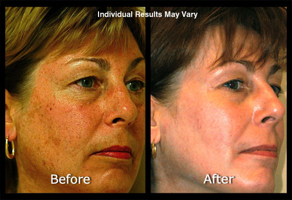 Photofacial Before and After
