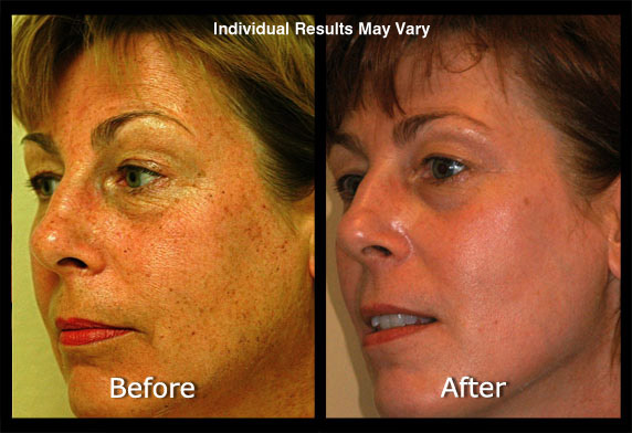 Photofacial Before and After